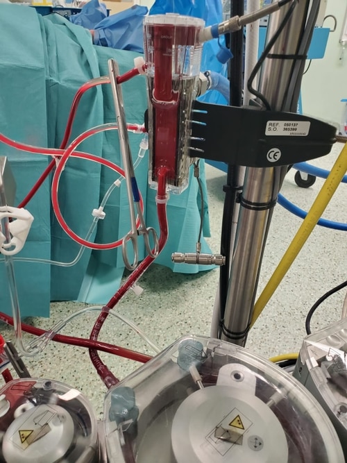 Close-up of cardioplegia delivery during cardiac surgery